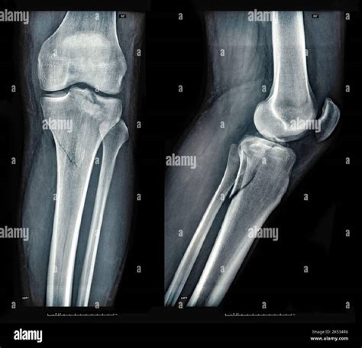 Scans that can reveal broken bones: Hyph.
